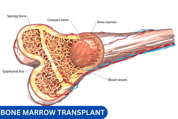 Трансплантация Костного Мозга